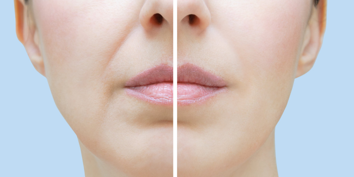 Hyaluron spritzen München