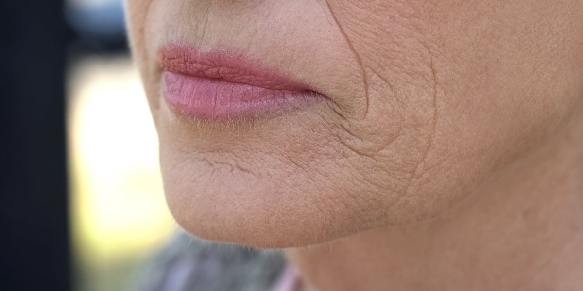 Marionettenfalten behandeln